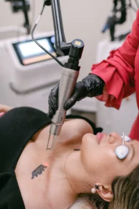 laser tattoo removal