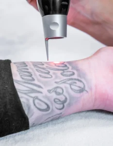 laser tattoo removal